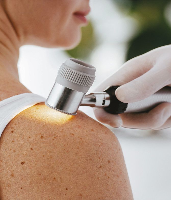 Prevence melanomu (posouzení kožních znamének)